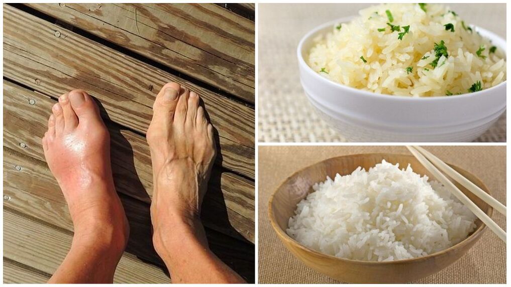 Rice based diet is recommended for arthritis patients. 
